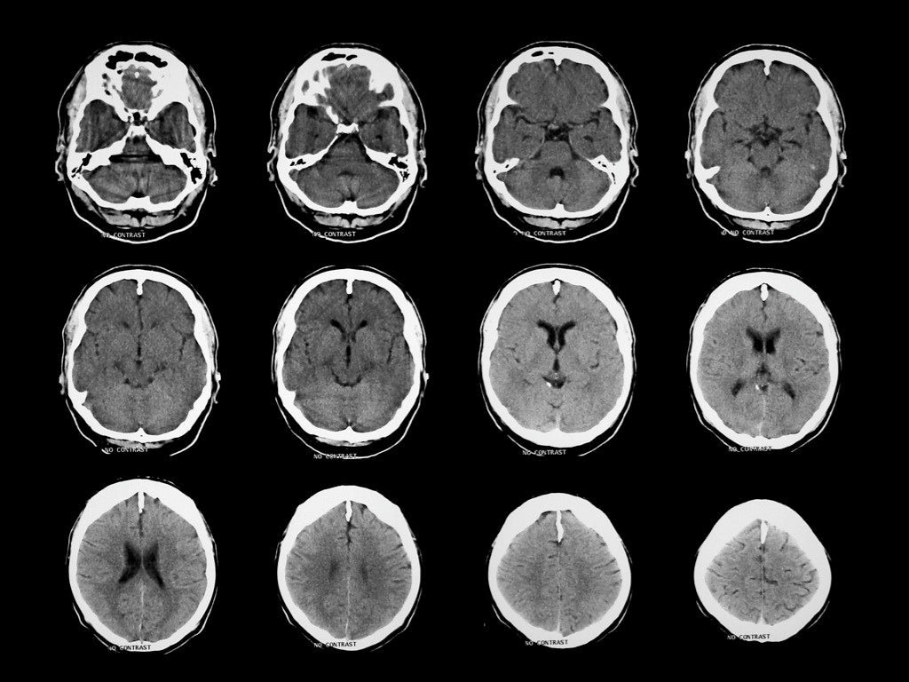 Stack suplementacyjny dla mózgu – substancje, które realnie wspierają koncentrację i pamięć